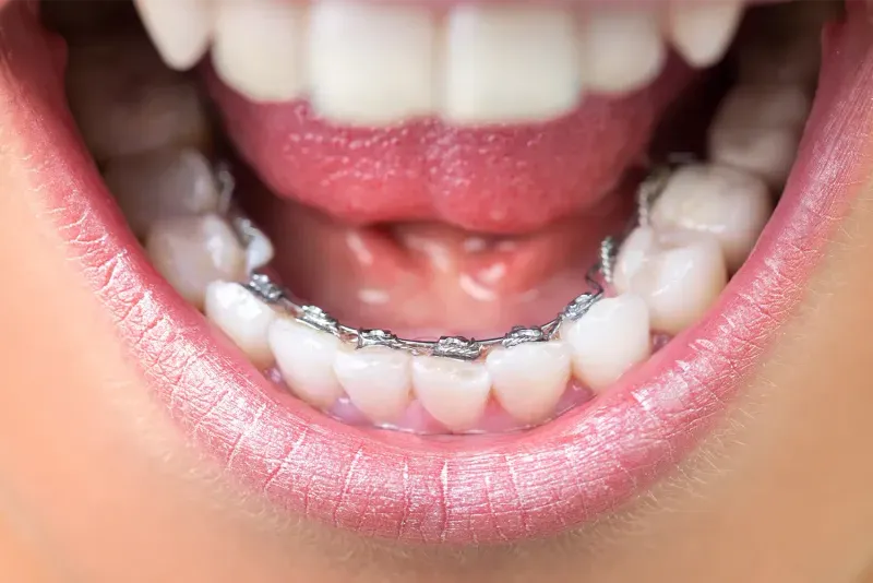 What are Hidden Braces?