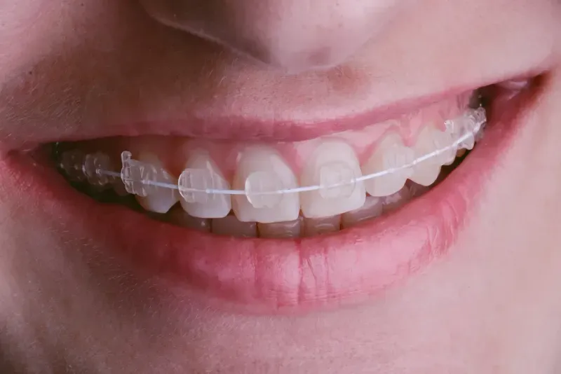 Ceramic Braces vs. Invisalign