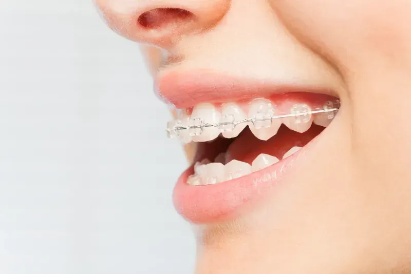 How Do You Take Care of Ceramic Braces?