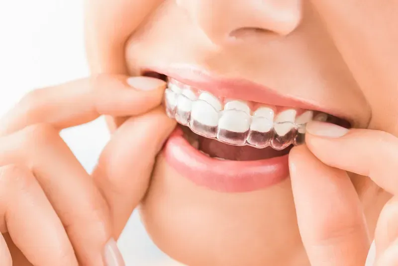 Invisalign vs. Traditional Braces