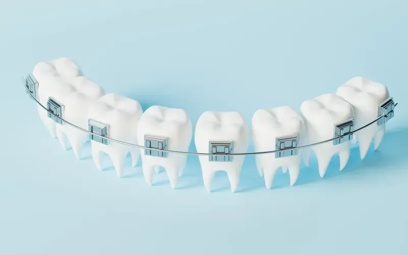 Is Orthodontic Treatment Expensive