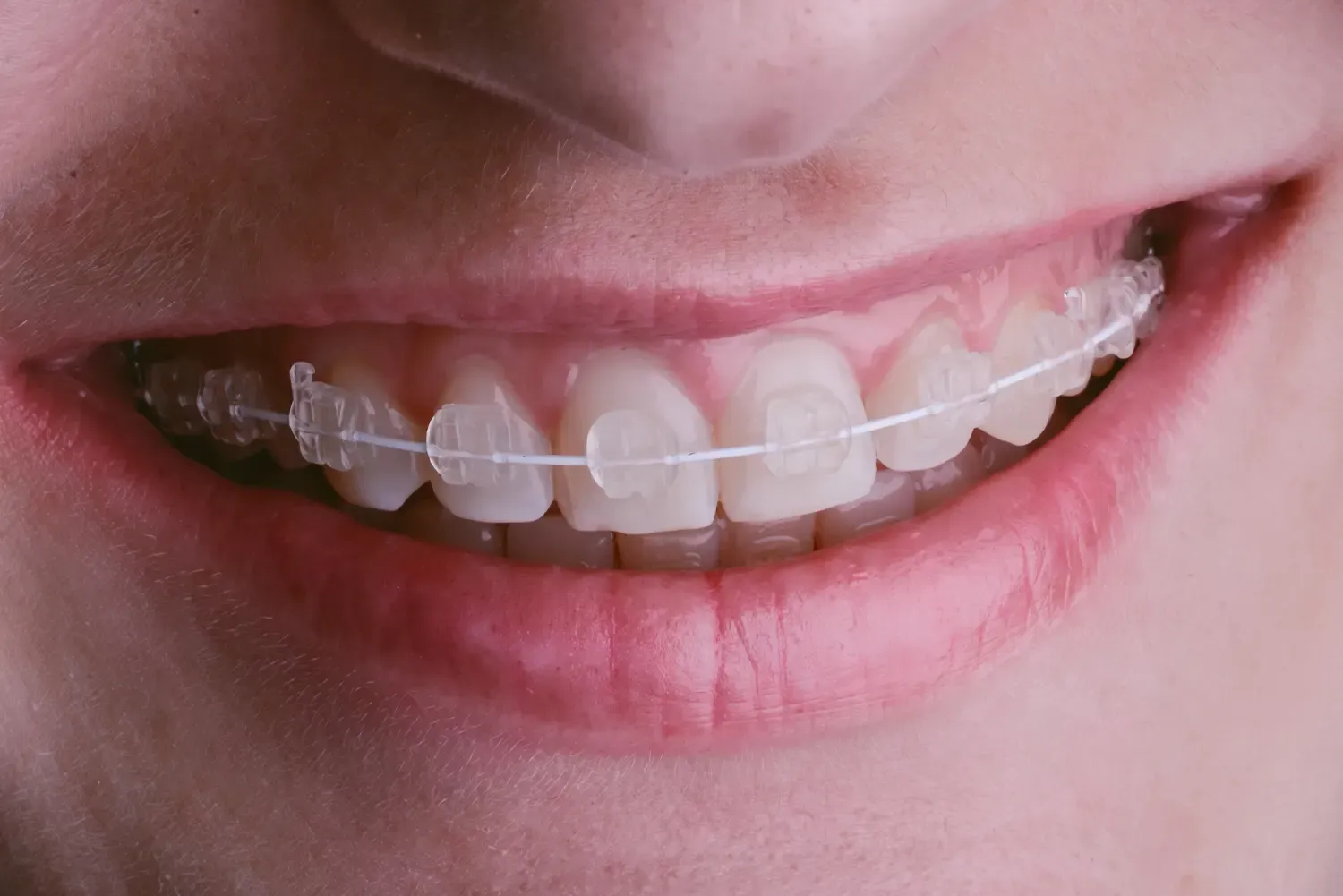 Ceramic Braces vs. Invisalign: Choosing the Right Aesthetic Treatment